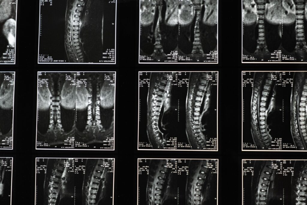 Beispiel einer MRT Aufnahme bei Verdacht auf Osteoporose.