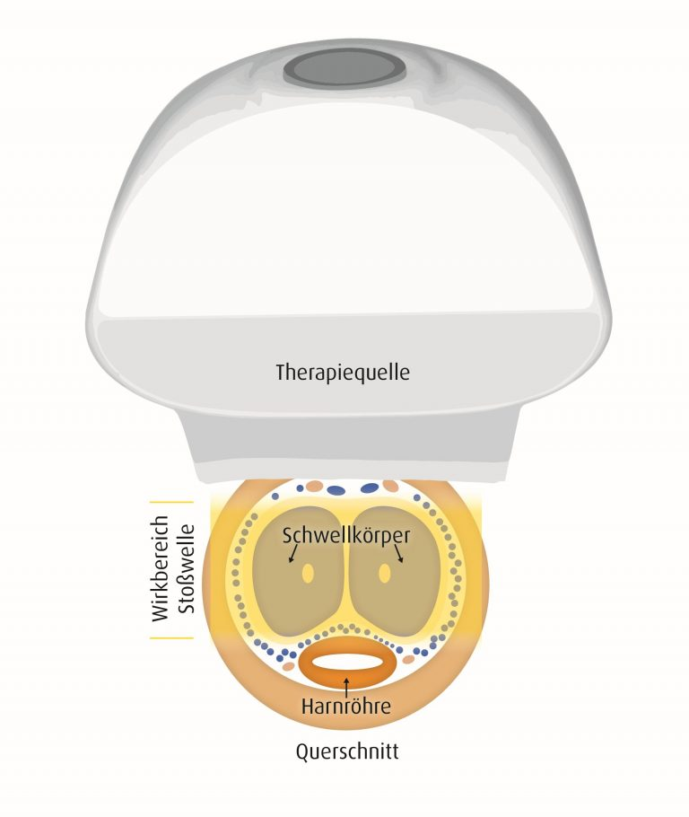 Schema zur Anwendung einer linearen Stoßwelle bei erektiler Dysfunktion. Zur Verfügung gestellt von der Fa. Schuhfried